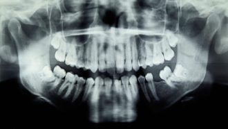 Panoramic X-Ray Image Of Teeth And Mouth
